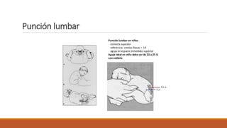 Punción lumbar
 