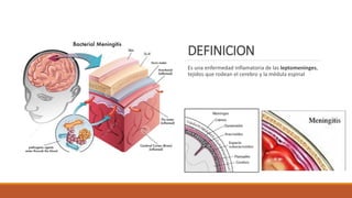 DEFINICION
Es una enfermedad inflamatoria de las leptomeninges,
tejidos que rodean el cerebro y la médula espinal
 
