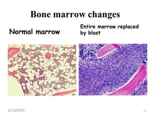 Bone marrow changes
Normal marrow
Entire marrow replaced
by blast
30
2/13/2023
 