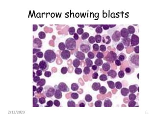 Marrow showing blasts
31
2/13/2023
 
