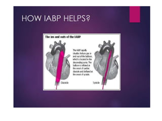 Intra Aortic Balloon Pump - All you need to know | PPTX