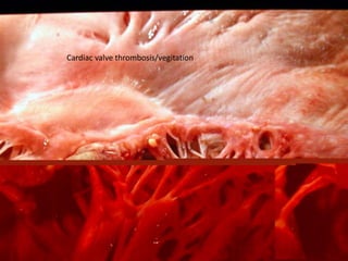 Cardiac valve thrombosis/vegitation
 