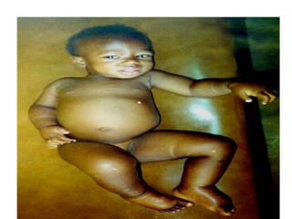 Morphology of edema
Grossly – easily recognizable
 