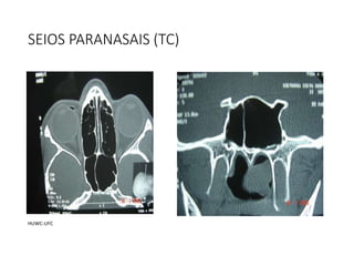 SEIOS PARANASAIS (TC)
HUWC-UFC
 