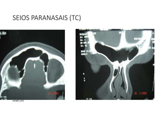 SEIOS PARANASAIS (TC)
HUWC-UFC
 