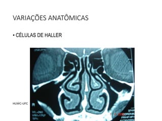 VARIAÇÕES ANATÔMICAS
• CÉLULAS DE HALLER
HUWC-UFC
 