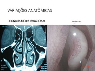 VARIAÇÕES ANATÔMICAS
• CONCHA MÉDIA PARADOXAL HUWC-UFC
 