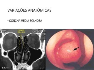VARIAÇÕES ANATÔMICAS
• CONCHA MÉDIA BOLHOSA
 