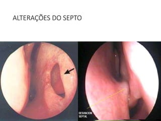 ALTERAÇÕES DO SEPTO
 