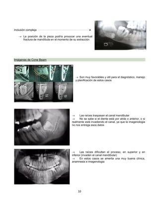 10
Inclusión compleja
® La posición de la pieza podría provocar una eventual
fractura de mandíbula en el momento de su extracción
Imágenes de Cone Beam
® Son muy favorables y útil para el diagnóstico, manejo
y planificación de estos casos
® Las raíces traspasan el canal mandibular
® No se sabe si el diente está por atrás o anterior, o si
realmente está invadiendo el canal, ya que la imagenologia
no nos entrega esos datos
® Las raíces dificultan el proceso, en superior y en
inferior (invaden el canal mandibular)
® En estos casos se amerita una muy buena clínica,
anamnesis e imagenologia
 