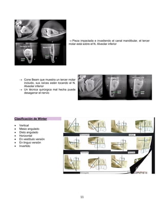 11
® Pieza impactada e invadiendo el canal mandibular, el tercer
molar está sobre el N. Alveolar inferior
® Cone Beam que muestra un tercer molar
incluido, sus raíces están tocando el N.
Alveolar inferior
® Un técnica quirúrgica mal hecha puede
desagarrar el nervio
Clasificación de Winter
• Vertical
• Mesio angulado
• Disto angulado
• Horizontal
• En vestíbulo versión
• En linguo versión
• Invertido
 