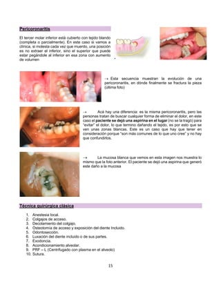 15
Pericoronaritis
El tercer molar inferior está cubierto con tejido blando
(completa o parcialmente). En este caso si vamos a
clínica, si molesta cada vez que muerdo, una posición
es no extraer el inferior, sino el superior que puede
estar pegándole al inferior en esa zona con aumento
de volumen
® Esta secuencia muestran la evolución de una
pericoronaritis, en dónde finalmente se fractura la pieza
(última foto)
® Acá hay una diferencia: es la misma pericoronaritis, pero las
personas tratan de buscar cualquier forma de eliminar el dolor, en este
caso el paciente se dejó una aspirina en el lugar (no se la tragó) para
“evitar” el dolor, lo que termino dañando el tejido, es por esto que se
ven unas zonas blancas. Este es un caso que hay que tener en
consideración porque “son más comunes de lo que uno cree” y no hay
que confundirlos.
® La mucosa blanca que vemos en esta imagen nos muestra lo
mismo que la foto anterior. El paciente se dejó una aspirina que generó
este daño a la mucosa
Técnica quirúrgica clásica
1. Anestesia local.
2. Colgajos de acceso.
3. Decolamiento del colgajo.
4. Osteotomía de acceso y exposición del diente Incluido.
5. Odontosección.
6. Luxación del diente incluido o de sus partes.
7. Exodoncia.
8. Acondicionamiento alveolar.
9. PRF – L (Centrifugado con plasma en el alveolo)
10. Sutura.
 