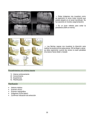 16
® Estas imágenes nos muestran como
se segmentó un terce molar incluído que
estaba alojado en el canal mandibular. Se
fue sacando en trocitos (segmentación)
® Es un buen método para evitar la
parestesia (Daño al nervio)
® Las flechas negras nos muestran la dirección para
realizar la exodoncia de estas piezas. NO es llegar y sacar,
se debe segmentar cuando las raíces no sean paralelas
(Curvatura hacia distal o mesial)
Procedimientos con mínimo trauma
1) Intenso entrenamiento
2) Conocimiento
3) Experiencia
4) Planificación
Planificación
• Historia médica
• Examen clínico
• Examen radiográfico
• Imágenes (Cone beam)
• Confirmar indicación de extracción
 