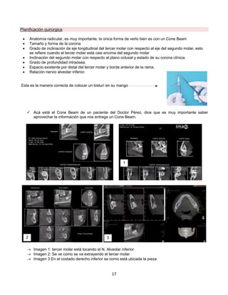 17
Planificación quirúrgica
• Anatomía radicular, es muy importante, la única forma de verlo bien es con un Cone Beam
• Tamaño y forma de la corona
• Grado de inclinación de eje longitudinal del tercer molar con respecto al eje del segundo molar, esto
se refiere cuando el tercer molar está casi encima del segundo molar
• Inclinación del segundo molar con respecto al plano oclusal y estado de su corona clínica.
• Grado de profundidad intraósea.
• Espacio existente por distal del tercer molar y borde anterior de la rama.
• Relación nervio alveolar inferior.
Esta es la manera correcta de colocar un bisturí en su mango
ü Acá está el Cone Beam de un paciente del Doctor Pérez, dice que es muy importante saber
aprovechar la información que nos entrega un Cone Beam.
® Imagen 1: tercer molar está tocando el N. Alveolar inferior
® Imagen 2: Se ve como se va extrayendo el tercer molar
® Imagen 3 En el costado derecho inferior se como está ubicada la pieza
1
2 3
 