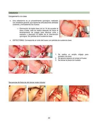 20
Osteotomía
Complemento a la clase
• Una osteotomía es un procedimiento quirúrgico, realizado
con anestesia general, que repara las articulaciones dañadas
cortando y remodelando los huesos
® Eliminación de tejido óseo con el fin de acceder al
área a tratar, este se realiza después de hacer el
levantamiento de colgajo para efectuar corte o
exeresis y descubrir el objeto de la intervención
quirúrgica. Sin pérdida de la sustancia ósea
• OSTECTOMIA: Corresponde al corte del hueso con pérdida de sustancia ósea
Secuencias de fotos de otro tercer molar incluido
1. Se realiza un amplio colgajo para
acceder a la zona
2. Se genera espacio al romper el hueso
3. Se extrae la pieza con luxador
 