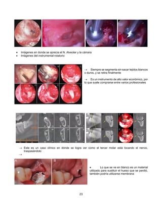 23
• Imágenes en donde se aprecia el N. Alveolar y la cámara
• Imágenes del instrumental rotatorio
® Siempre se segmenta sin sacar tejidos blancos
o duros, y se retira finalmente
® Es un instrumento de alto valor económico, por
lo que suele comprarse entre varios profesionales
® Este es un caso clínico en dónde se logra ver como el tercer molar está tocando el nervio,
traspasándolo
®
• Lo que se ve en blanco es un material
utilizado para sustituir el hueso que se perdió,
también podría utilizarse membrana
 