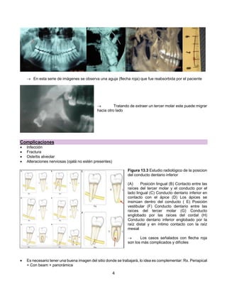 4
® En esta serie de imágenes se observa una aguja (flecha roja) que fue reabsorbida por el paciente
® Tratando de extraer un tercer molar este puede migrar
hacia otro lado
Complicaciones
• Infección
• Fractura
• Osteítis alveolar
• Alteraciones nerviosas (ojalá no estén presentes)
Figura 13.3 Estudio radiológico de la posicion
del conducto dentario inferior
(A) Posición lingual (B) Contacto entre las
raíces del tercer molar y el conducto por el
lado lingual (C) Conducto dentario inferior en
contacto con el ápice (D) Los ápices se
insinúan dentro del conducto ( E) Posición
vestibular (F) Conducto dentario entre las
raíces del tercer molar (G) Conducto
englobado por las raíces del cordal (H)
Conducto dentario inferior englobado por la
raíz distal y en íntimo contacto con la raíz
mesial
® Los casos señalados con flecha roja
son los más complicados y difíciles
• Es necesario tener una buena imagen del sitio donde se trabajará, lo idea es complementar: Rx. Periapical
+ Con beam + panorámica
 