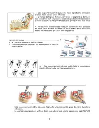 5
® Este esquema muestra lo que podría haber o producirse en relación
al tercer molar con las raíces inferiores
® El manejo de la pieza de mano, con la que se segmenta el diente, en
esta posición es MUY peligrosa. La pieza está prácticamente acostada en
el nervio alveolar, y lo más probable es que se genere un daño en el nervio
• NO se puede abarcar desde vestibular, sería mucho más peligroso.
En estos casos lo ideal es utilizar un PIEZOELEGTRICO, el cual no
trabaja con fresas sino que utiliza otros dispositivos
PIEZOELEGTRICO
• NO utiliza un sistema de piedras o fresas
• Es costoso pero con los años a ido disminuyendo su valor, es
más accesible
® Este esquema muestra lo que podría haber o producirse en
relación al tercer molar con las raíces inferiores
® Este esquema muestra cómo se podría fragmentar una pieza dental (pieza de mano) durante su
extracción.
® Lo ideal es realizar posterior un Cone Beam para saber si está anterior o posterior a algún NERVIO
 