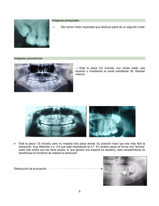 9
Imágenes periapicales
® Otro tercer molar impactado que destruyó parte de un segundo molar
Imágenes panorámicas
® Está la pieza 4.8 incluida, sus raíces están casi
tocando o invadiendo el canal mandibular (N. Alveolar
inferior)
• Está la pieza 1.8 incluida, pero no impacta otra pieza dental. Su posición hace que sea más fácil la
extracción, muy diferente a a 2.8 que está impactando la 2.7. En ambos casos se forma una “terraza”
(está más arriba que las otras piezas, lo que genera una especie es escalón), esta características es
beneficiosa al momento de realizar la extracción
Obstrucción de la erupción
 