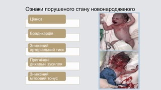 Ознаки порушеного стану новонародженого
Ціаноз
Брадикардія
Знижений
артеріальний тиск
Пригнічені
дихальні зусилля
Знижений
м’язовий тонус
 