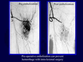 Post Embolization Rash Pathologic Fractures orthopedics trauma | PPT