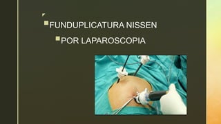 6-equipo-3-funduplicatura-de-nissen-pptx