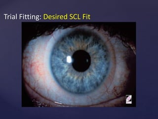 6. Pre-fitting Assessment of rgp lens.ppt
