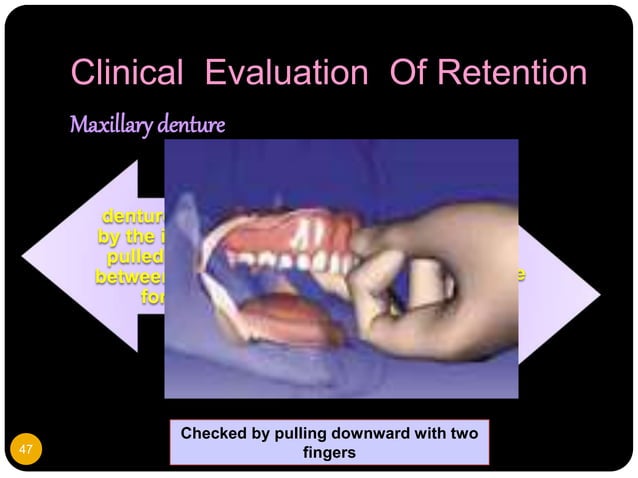 Support Stability Retention Rpd 6.Retention, stability and support in complete denture.pptx | Oral care ...