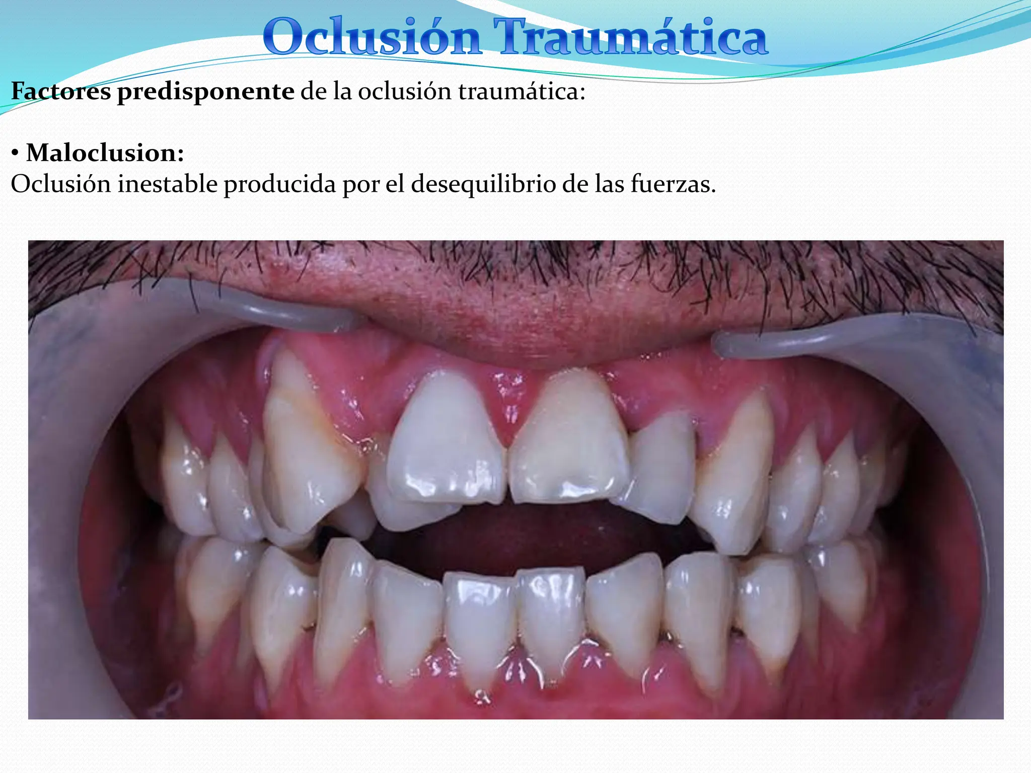 6. ALTERACIONES Y TRANSTORNOS COMUNES DE LA OCLUSION.pptx