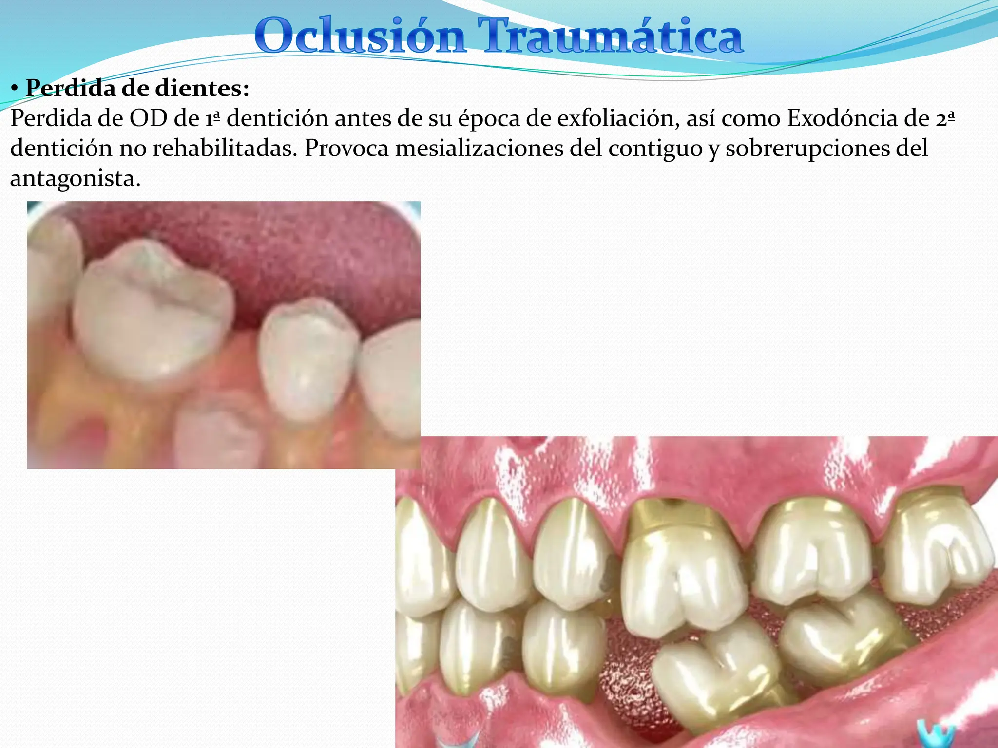 6. ALTERACIONES Y TRANSTORNOS COMUNES DE LA OCLUSION.pptx