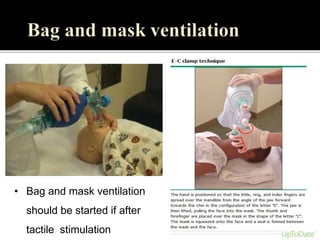 • Bag and mask ventilation
should be started if after
tactile stimulation
 