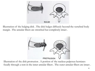 Diffusely Bulging Disc Biomedical engineering and biomedical research | PDF
