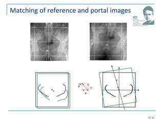 Matching of reference and portal images
X
Y
P

12/42
 
