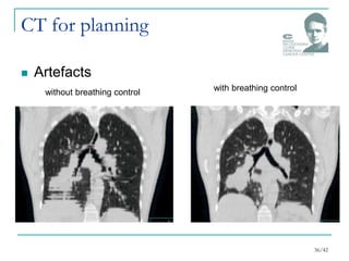 CT for planning
 Artefacts
36/42
without breathing control with breathing control
 