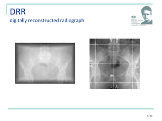 DRR
digitally reconstructed radiograph
8/42
 
