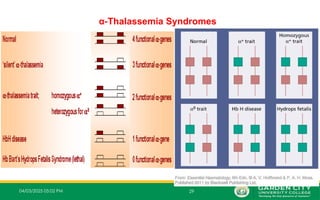 04/03/2025 05:02 PM 29
α‐Thalassemia Syndromes
 