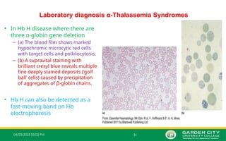 04/03/2025 05:02 PM 31
Laboratory diagnosis α‐Thalassemia Syndromes
• In Hb H disease where there are
three α‐globin gene deletion
– (a) The blood film shows marked
hypochromic microcytic red cells
with target cells and poikilocytosis.
– (b) A supravital staining with
brilliant cresyl blue reveals multiple
fine deeply stained deposits (‘golf
ball’ cells) caused by precipitation
of aggregates of β‐globin chains.
• Hb H can also be detected as a
fast‐moving band on Hb
electrophoresis
 