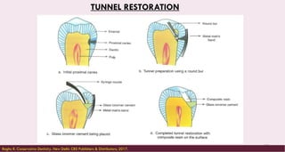 158
TUNNEL RESTORATION
Raghu R. Conservative Dentistry. New Delhi: CBS Publishers & Distributors; 2017.
 
