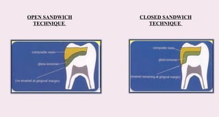 OPEN SANDWICH
TECHNIQUE
CLOSED SANDWICH
TECHNIQUE
 