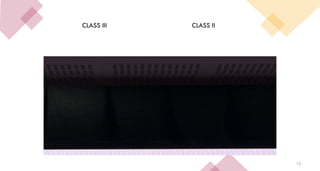 75
CLASS III CLASS II
 