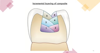76
Incremental layering of composite
 
