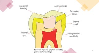77
Schematic signs and symptoms caused by
polymerization shrinkage.
 