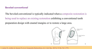 95
Beveled conventional
The beveled conventional is typically indicated when a composite restoration is
being used to replace an existing restoration exhibiting a conventional tooth
preparation design with enamel margins or to restore a large area.
1. Lahari K, Jaidka S, Somani R et al. Composite Restorations. Int J Adv Res. 2019; 7(10): 761-779.​
 