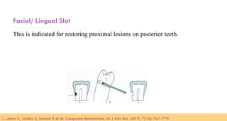 97
Facial/ Lingual Slot
This is indicated for restoring proximal lesions on posterior teeth.
1. Lahari K, Jaidka S, Somani R et al. Composite Restorations. Int J Adv Res. 2019; 7(10): 761-779.​
 
