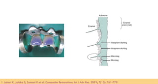 99
1. Lahari K, Jaidka S, Somani R et al. Composite Restorations. Int J Adv Res. 2019; 7(10): 761-779.​
 