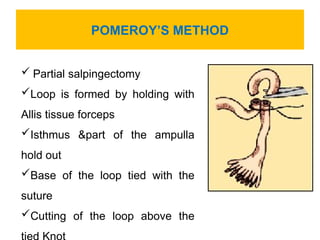 Pomeroy Method Methods of contraception in Fly welfare | PPT