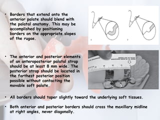 MAJOR CONNECTORS IN REMOVABLE PARTIAL DENTURE | PPTX