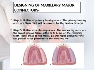 MAJOR CONNECTORS IN REMOVABLE PARTIAL DENTURE | PPTX