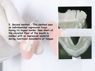 MAJOR CONNECTORS IN REMOVABLE PARTIAL DENTURE | PPTX