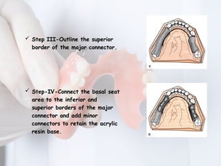 MAJOR CONNECTORS IN REMOVABLE PARTIAL DENTURE | PPTX